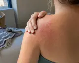 Spalla arrossata e irritata, con piccoli brufoli rossi, che indica prurito dopo piscina.