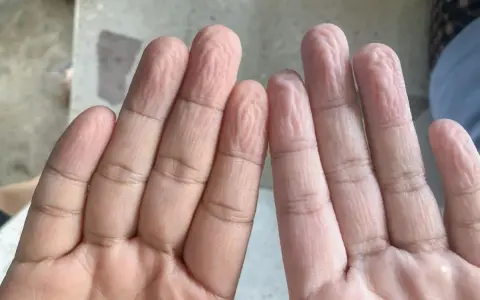 Dita raggrinzite in acqua, un fenomeno che ci fa chiedere perché le mani si raggrinziscono subito in acqua.