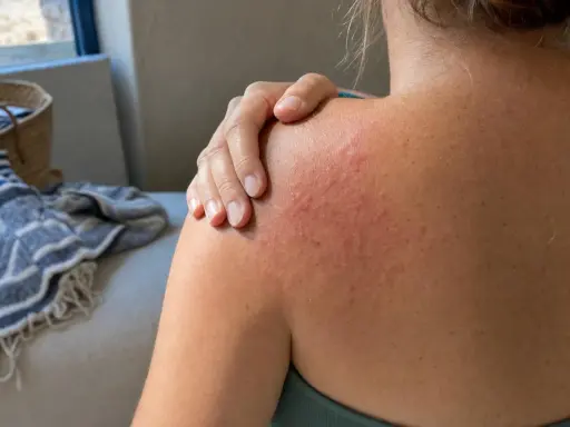 Spalla arrossata e irritata, con piccoli brufoli rossi, che indica prurito dopo piscina.
