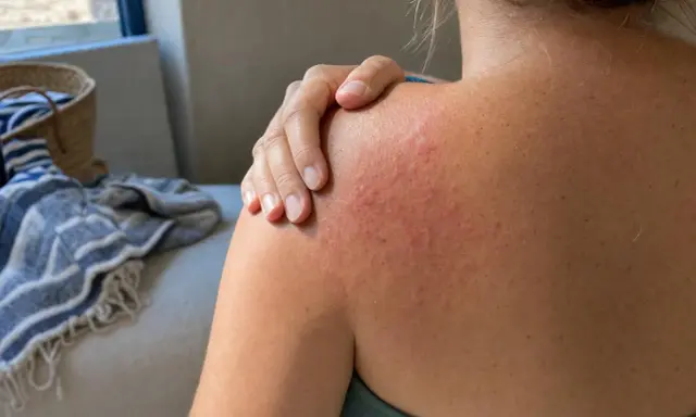 Spalla arrossata e irritata, con piccoli brufoli rossi, che indica prurito dopo piscina.