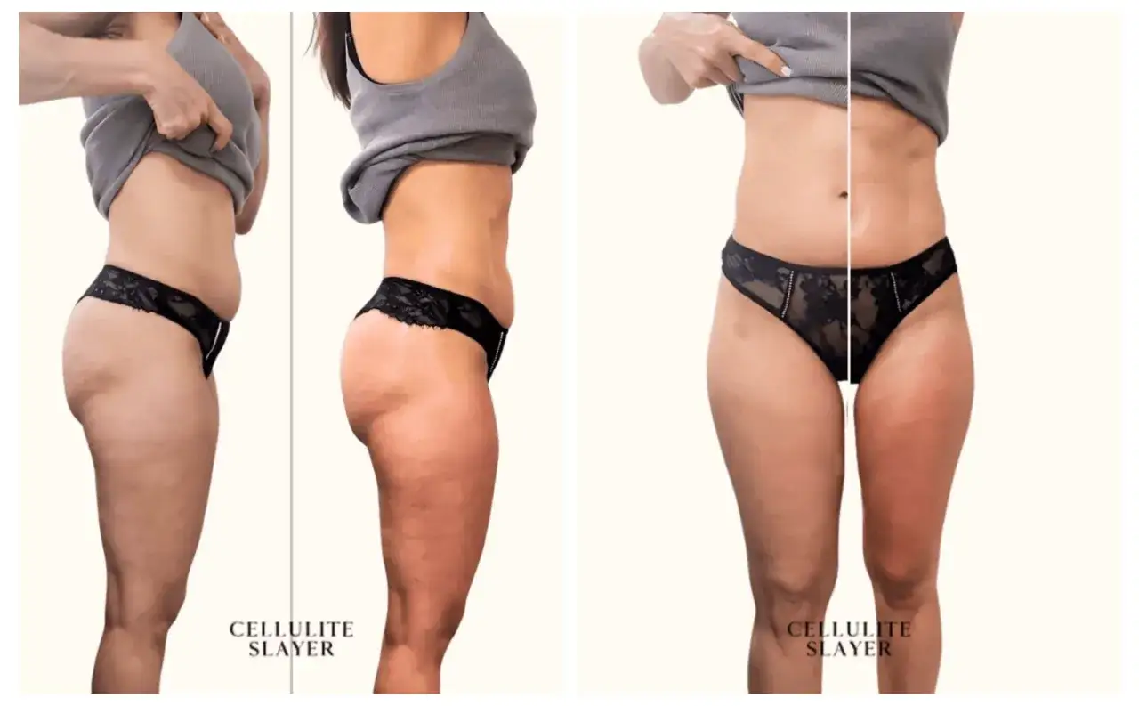 Confronto nuoto cellulite prima e dopo: gambe pi&ugrave; lisce e toniche.